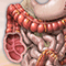 Colon cancer
