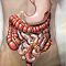 Ulcerative colitis