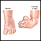 Clubfoot repair - series