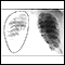 Aortic rupture - chest X-ray