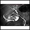 Cholecystitis - cholangiogram