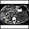 Kidney and liver cysts - CT scan