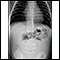 Intussusception - X-ray