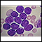 Acute lymphocytic leukemia - photomicrograph