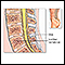 Spinal bone graft - series