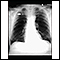 Pulmonary nodule - front view chest x-ray