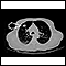 Lung mass, right upper lobe - CT scan