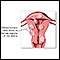 Fibroid tumors