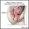 Pelvic adhesions