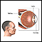 CMV retinitis