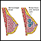 Fibrocystic breast change