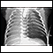 Pneumothorax - chest X-ray