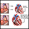 Alcoholic cardiomyopathy