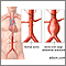 Aortic aneurysm