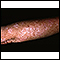 Actinic keratosis on the arm