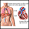 Dilated cardiomyopathy