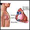 Pericarditis