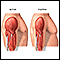 Active vs. inactive muscle