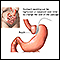 Adjustable gastric banding