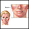 Rosacea