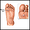 Plantar wart