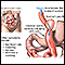 Dumping syndrome