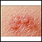 Herpes zoster (shingles) - close-up of lesion