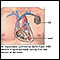 Implantable cardioverter-defibrillator