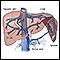 Transjugular intrahepatic portosystemic shunt