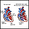 Atrioventricular canal (endocardial cushion defect)