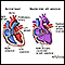 Double inlet left ventricle