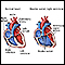 Double outlet right ventricle