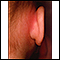 Mastoiditis - redness and swelling behind ear