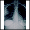 Aspergillosis - chest X-ray