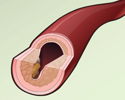 Cardiac and vascular disorders: Blood clots