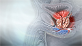 Prostate cancer