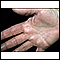 Hyperlinearity in atopic dermatitis - on the palm