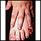 Epidermolysis bullosa, dominant dystrophic