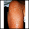 Exfoliation following erythroderma