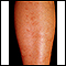 Polyarteritis - microscopic on the shin