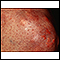 Xanthoma on the knee