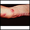 Sporotrichosis on the arm