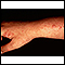 Polymorphic light eruption on the arm