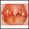 Mononucleosis - view of the throat