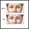 Before and after strabismus repair