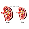 Changes in kidney with age