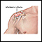 Bursitis of the shoulder