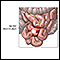 Meckel diverticulum