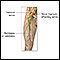 Femoral nerve damage