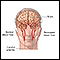 Transient Ischemic attack (TIA)